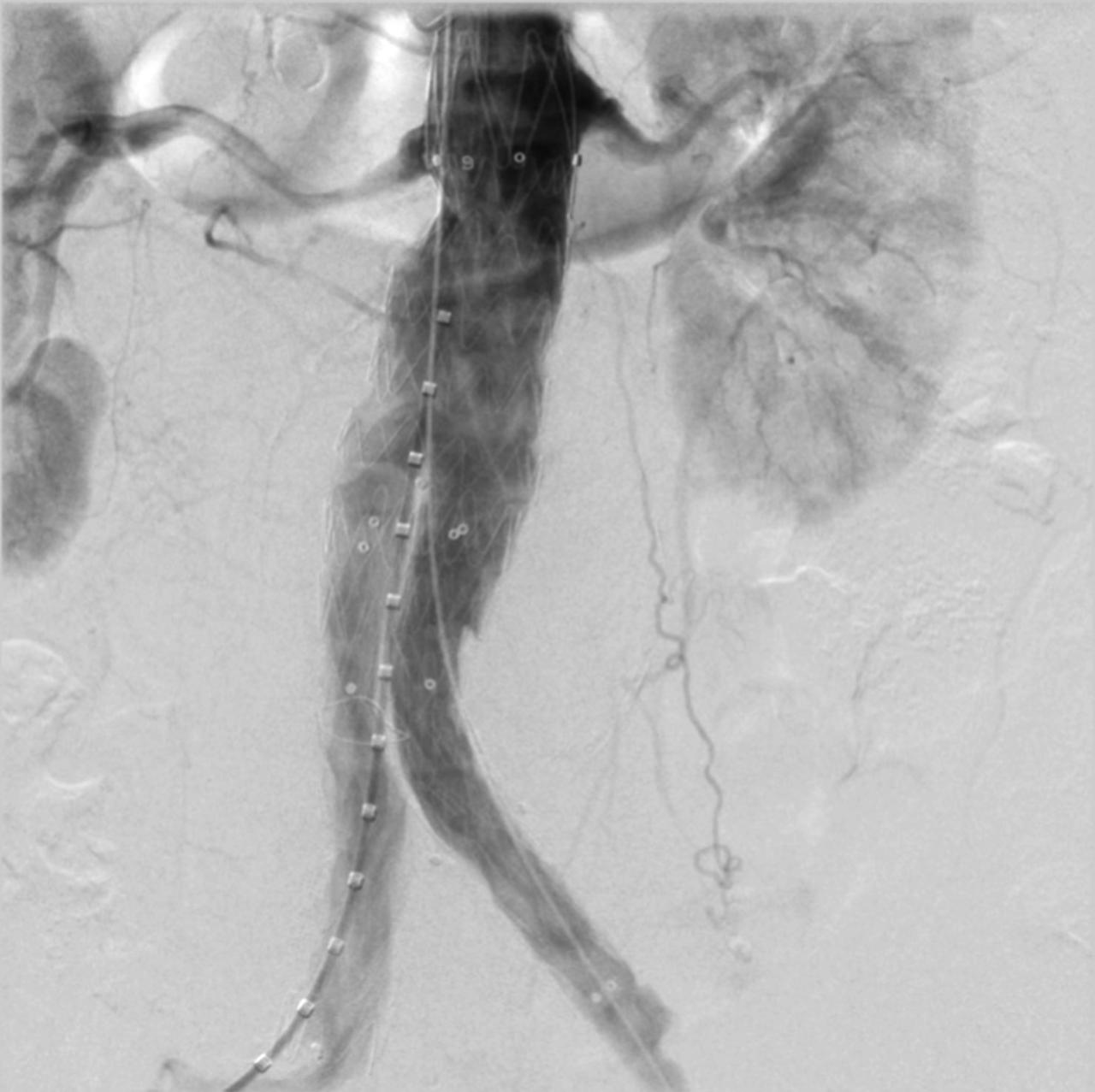 O que é o Aneurisma de Aorta e quais os riscos, salvador dr. davi seixas O que é o Aneurisma de Aorta e quais os riscos, salvador dr. davi seixas