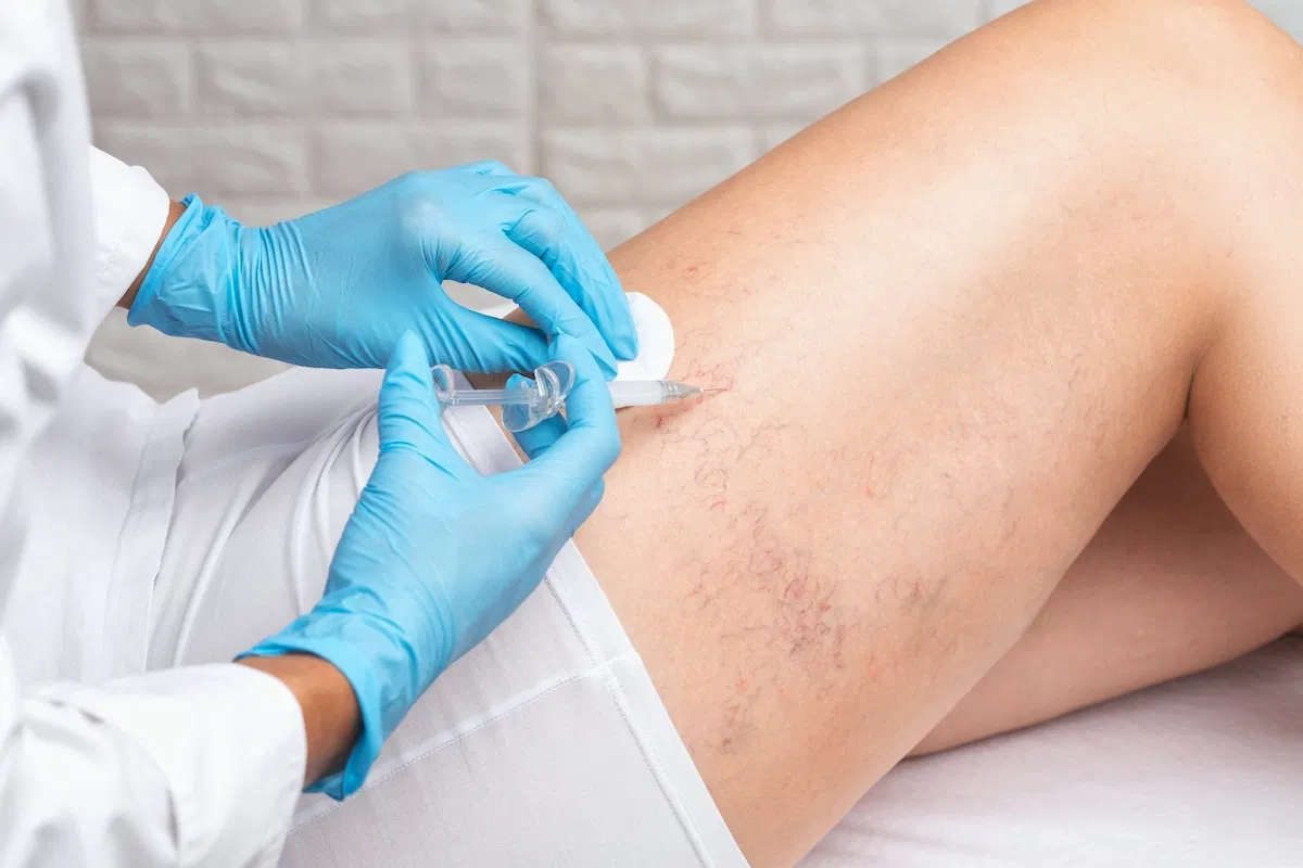 https://daviseixasvascular.com.br/wp-content/uploads/2026/03/indicacoes-para-escleroterapia-com-espuma-salvador.webp