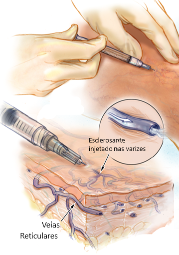 https://daviseixasvascular.com.br/wp-content/uploads/2026/03/o-que-e-Escleroterapia-liquida-salvador.webp