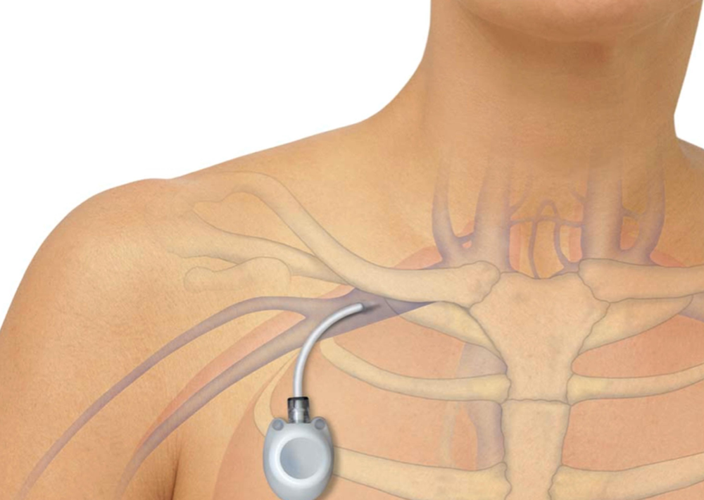 implante de catéteres de quimioterapia em salvador dr. davi seixas implante de catéteres de quimioterapia em salvador dr. davi seixas