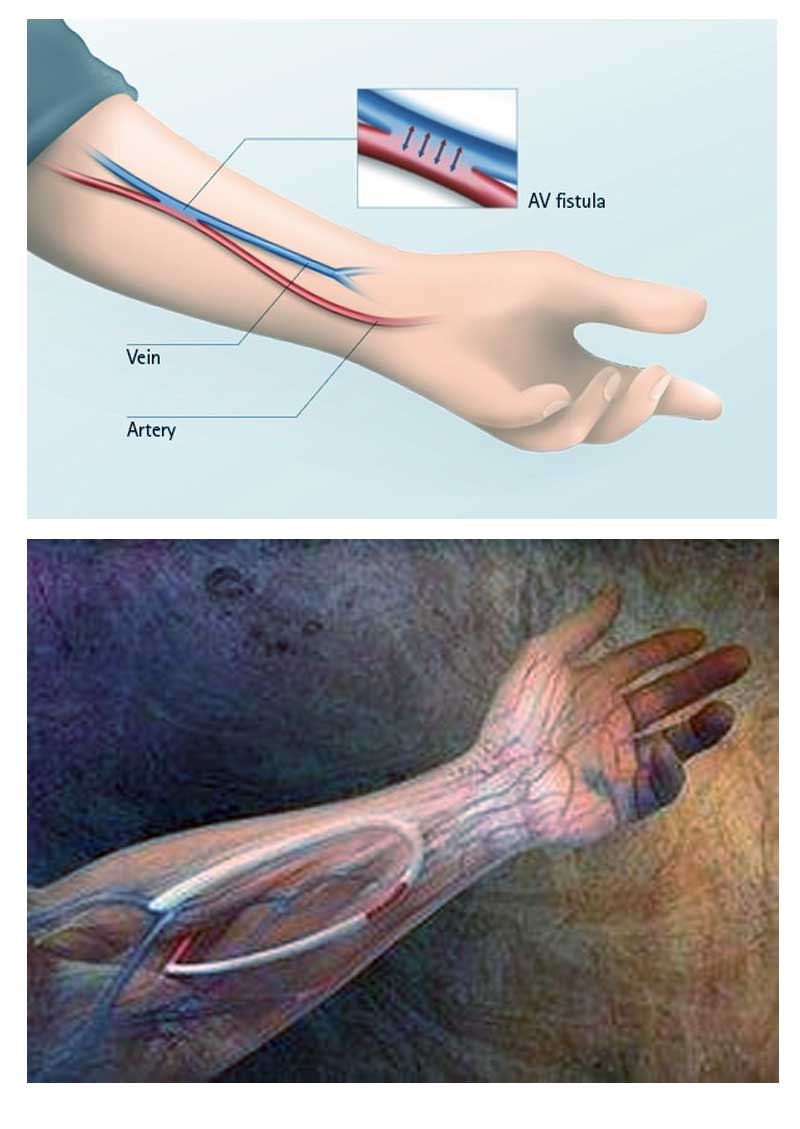 https://daviseixasvascular.com.br/wp-content/uploads/2026/03/o-que-e-uma-Confeccao-de-fistulas-arterio-venosas-salvador.jpg