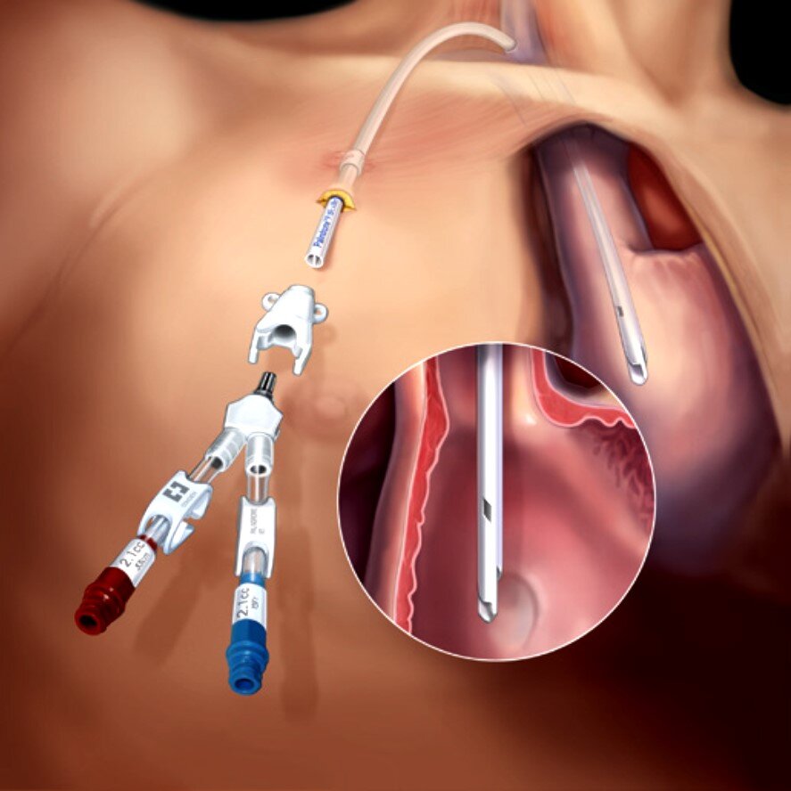 Tipos de Cateteres: Curta Permanência vs. Longa Permanência (Permcath) Tipos de Cateteres: Curta Permanência vs. Longa Permanência (Permcath)